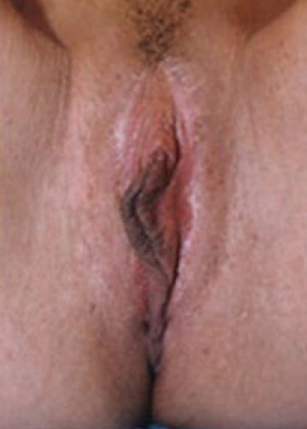 Female Enhancement Before & After Gallery - Patient 5883444 - Image 2