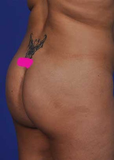 Brazilian Butt Lift Before & After Gallery - Patient 5883452 - Image 1