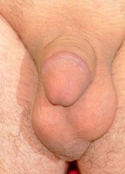 Male Enhancement Before & After Gallery - Patient 5883455 - Image 1