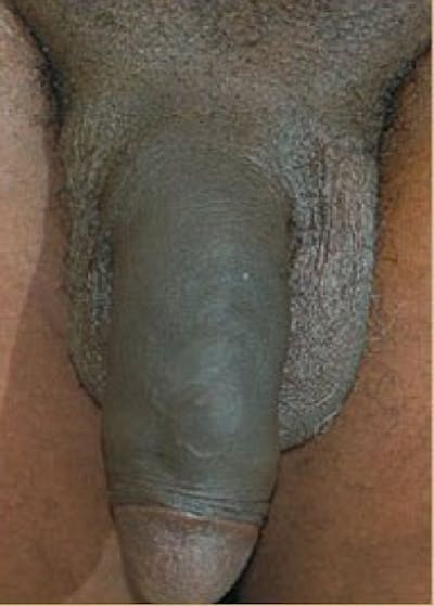 Male Enhancement Before & After Gallery - Patient 5883459 - Image 2