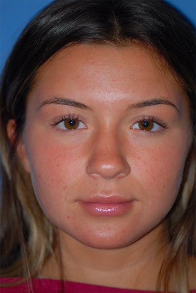 Rhinoplasty Before & After Gallery - Patient 5883724 - Image 1