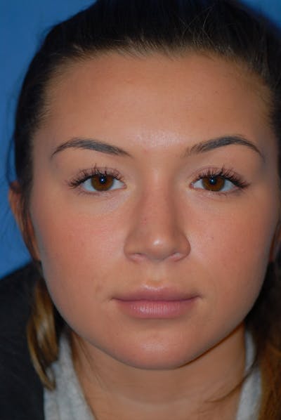 Rhinoplasty Before & After Gallery - Patient 5883724 - Image 2