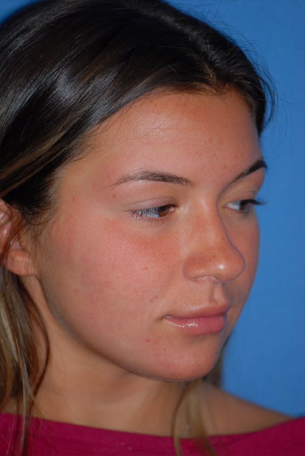 Rhinoplasty Before & After Gallery - Patient 5883724 - Image 3
