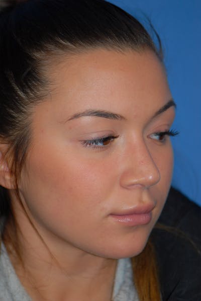 Rhinoplasty Before & After Gallery - Patient 5883724 - Image 4