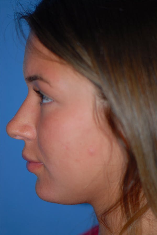 Rhinoplasty Before & After Gallery - Patient 5883724 - Image 5