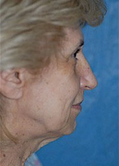 Facelift and Mini Facelift Before & After Gallery - Patient 5883726 - Image 1