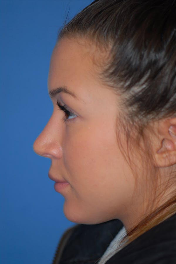 Rhinoplasty Before & After Gallery - Patient 5883724 - Image 6