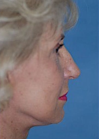 Facelift and Mini Facelift Before & After Gallery - Patient 5883726 - Image 2