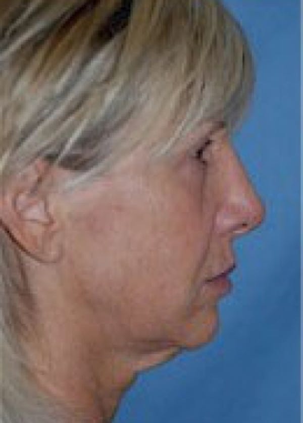 Facelift and Mini Facelift Gallery - Patient 5883732 - Image 1