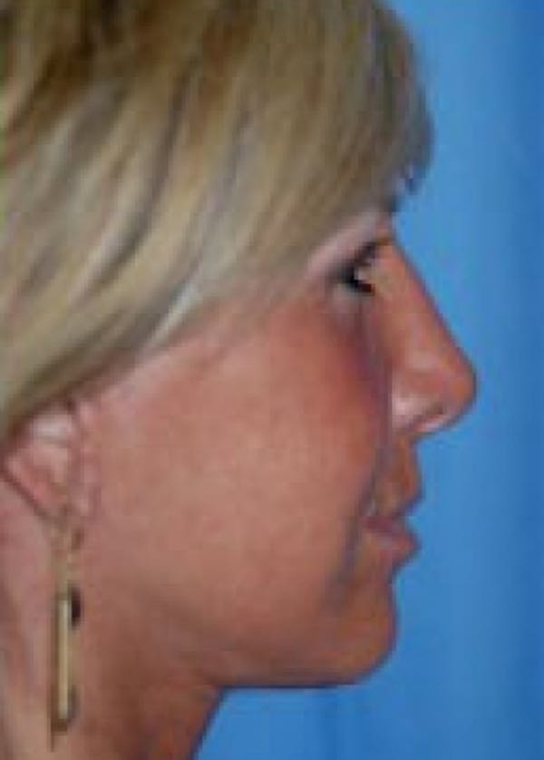 Facelift and Mini Facelift Before & After Gallery - Patient 5883732 - Image 2