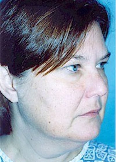 Facelift and Mini Facelift Before & After Gallery - Patient 5883733 - Image 1