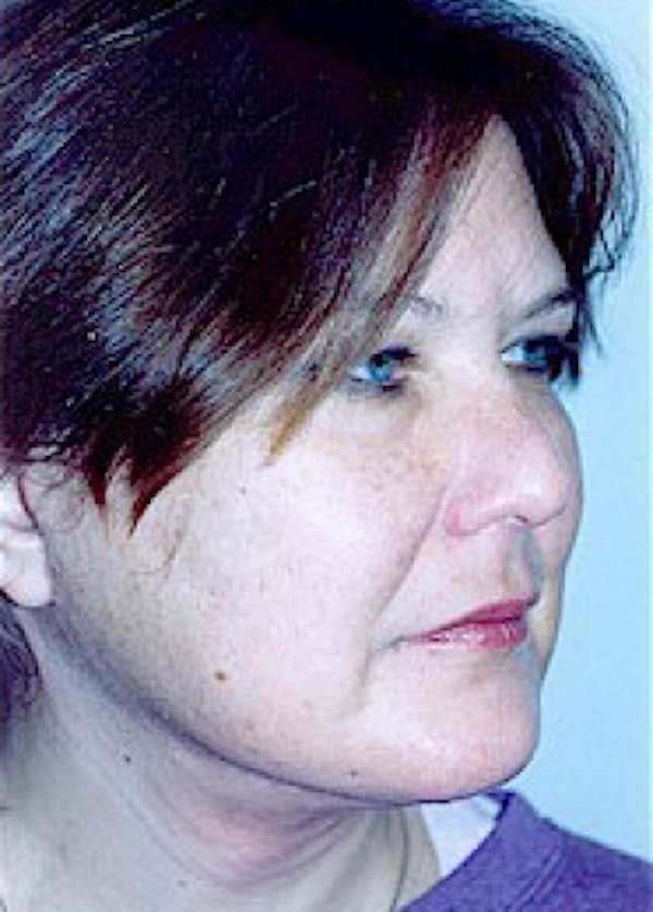 Facelift and Mini Facelift Before & After Gallery - Patient 5883733 - Image 2