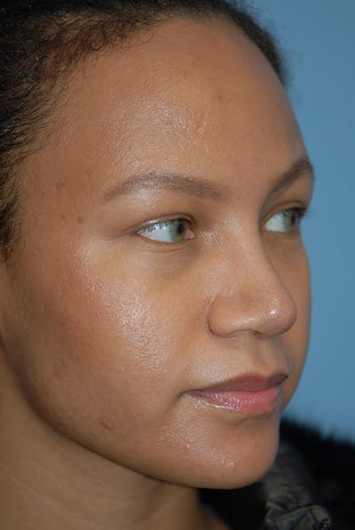 Rhinoplasty Before & After Gallery - Patient 5883737 - Image 4