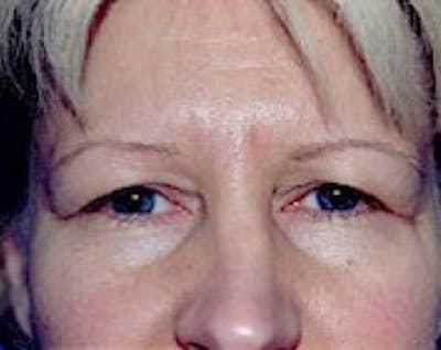 Eyelid Surgery Browlift Before & After Gallery - Patient 5883734 - Image 1