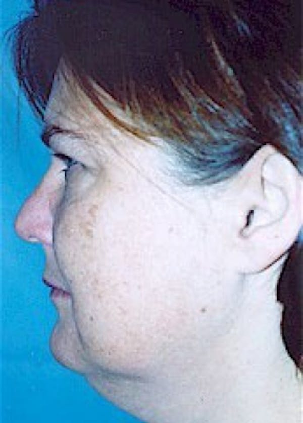 Facelift and Mini Facelift Before & After Gallery - Patient 5883733 - Image 3