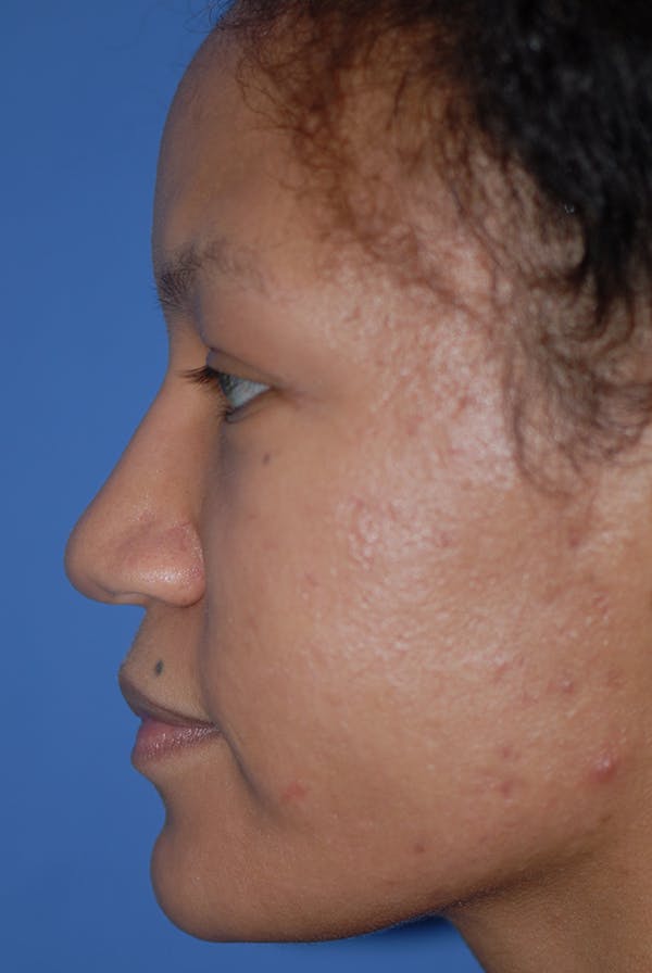 Rhinoplasty Before & After Gallery - Patient 5883737 - Image 5