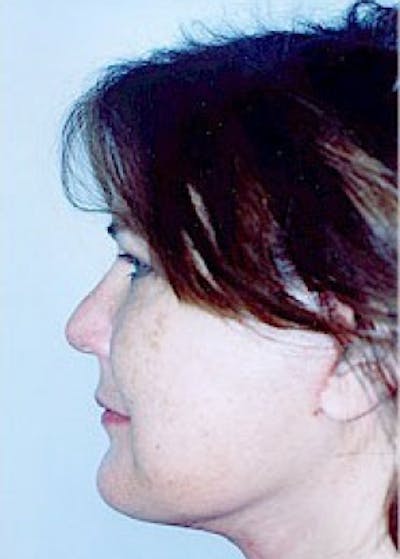 Facelift and Mini Facelift Gallery - Patient 5883733 - Image 4