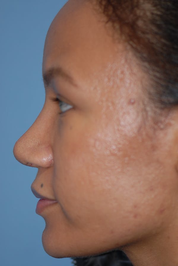 Rhinoplasty Before & After Gallery - Patient 5883737 - Image 6