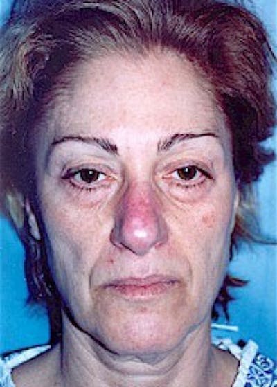 Plastic surgery patient at Allure Plastic Surgery