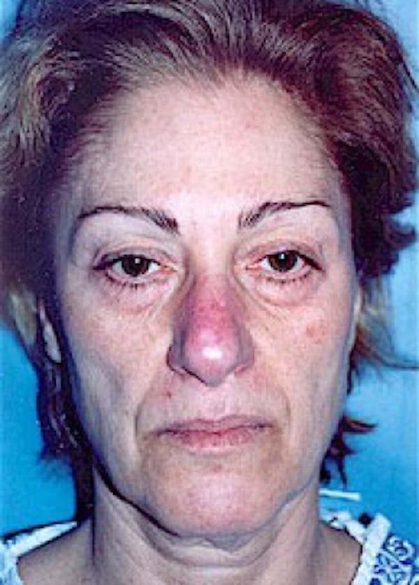 Facelift and Mini Facelift Before & After Gallery - Patient 5883736 - Image 1