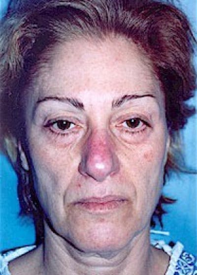 Facelift and Mini Facelift Before & After Gallery - Patient 5883736 - Image 1