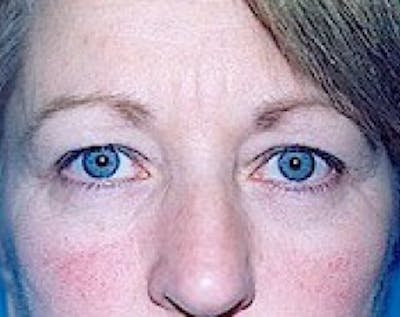 Eyelid Surgery Browlift Before & After Gallery - Patient 5883735 - Image 1
