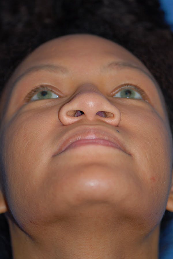 Rhinoplasty Before & After Gallery - Patient 5883737 - Image 7