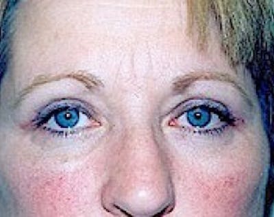 Eyelid Surgery Browlift Before & After Gallery - Patient 5883735 - Image 2