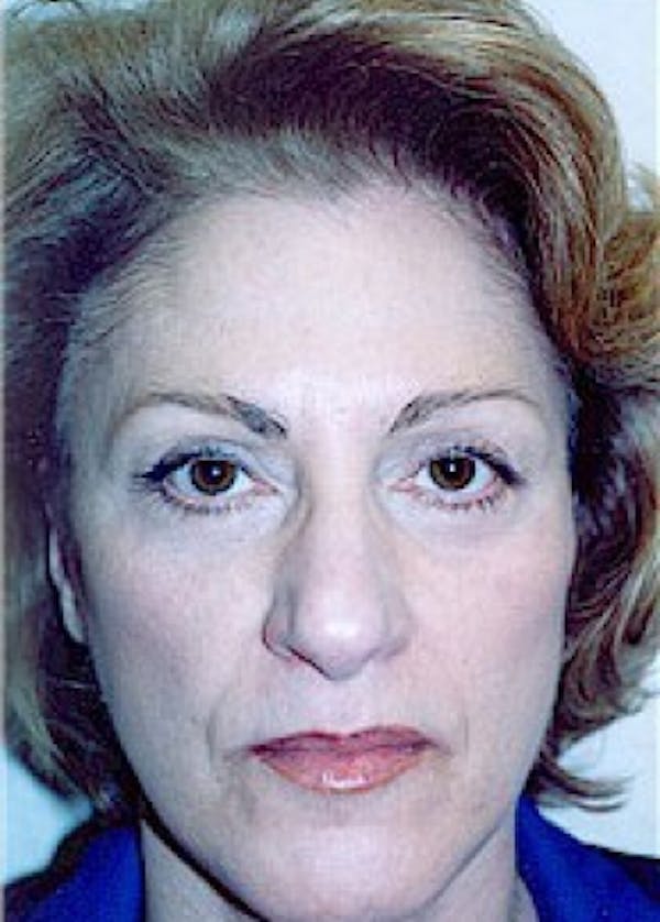 Facelift and Mini Facelift Gallery - Patient 5883736 - Image 2