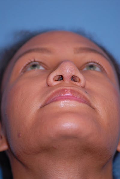 Rhinoplasty Before & After Gallery - Patient 5883737 - Image 8