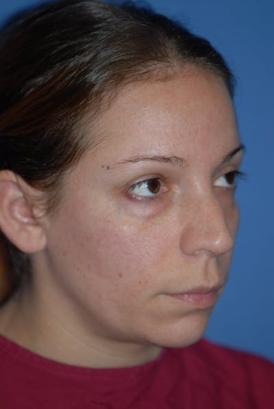 Rhinoplasty Before & After Gallery - Patient 5883741 - Image 1