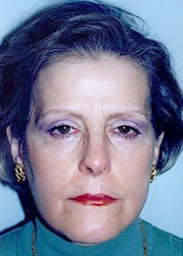 Eyelid Surgery Browlift Before & After Gallery - Patient 5883738 - Image 2