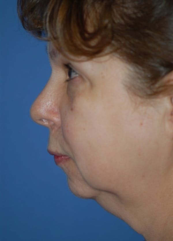 Plastic surgery patient at Allure Plastic Surgery