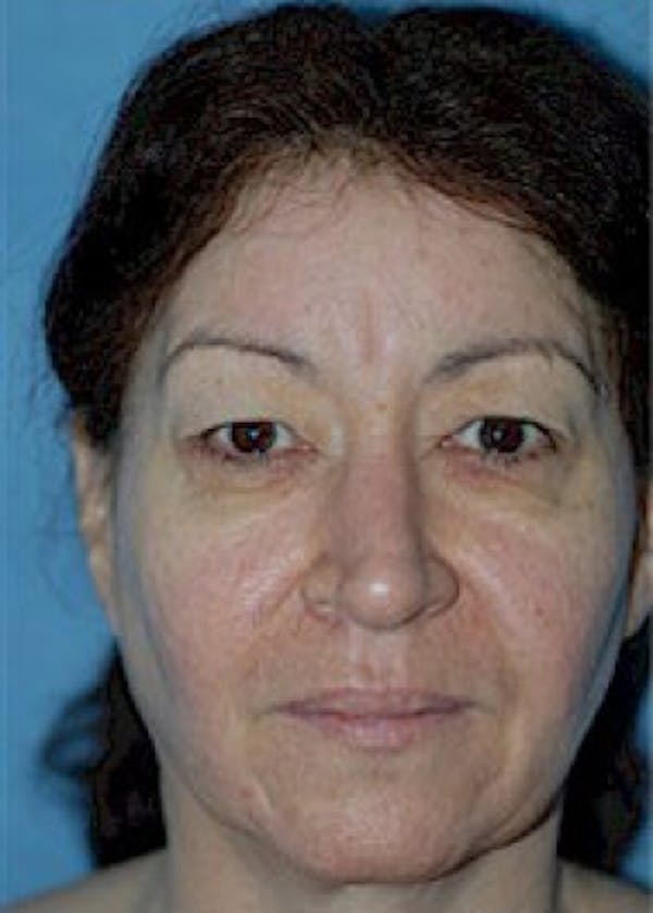 Eyelid Surgery Browlift Before & After Gallery - Patient 5883740 - Image 1