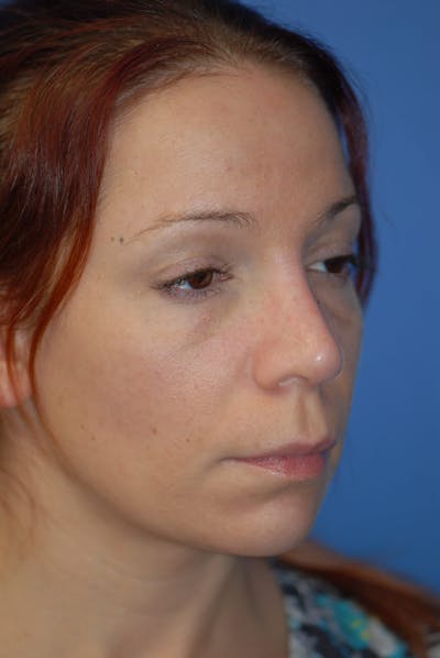 Rhinoplasty Before & After Gallery - Patient 5883741 - Image 2