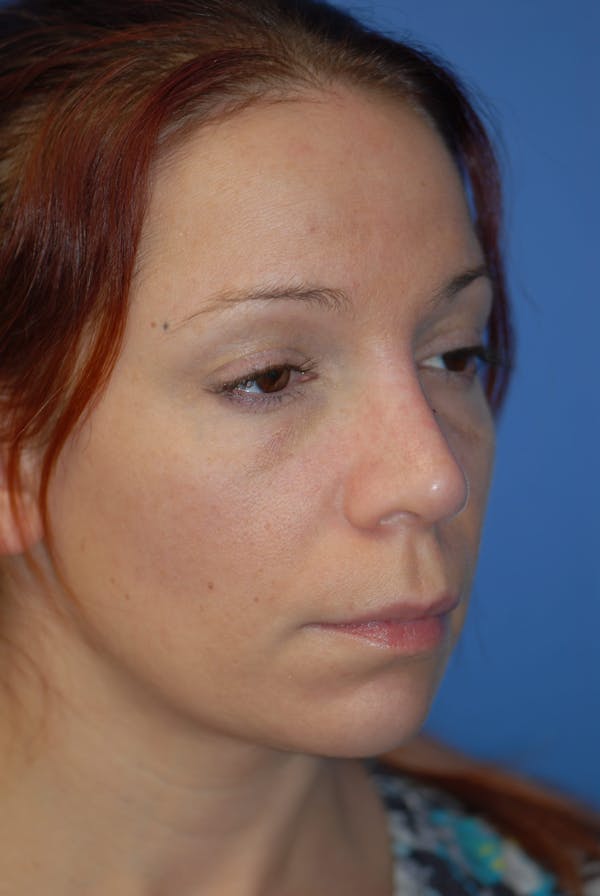 Rhinoplasty Before & After Gallery - Patient 5883741 - Image 2