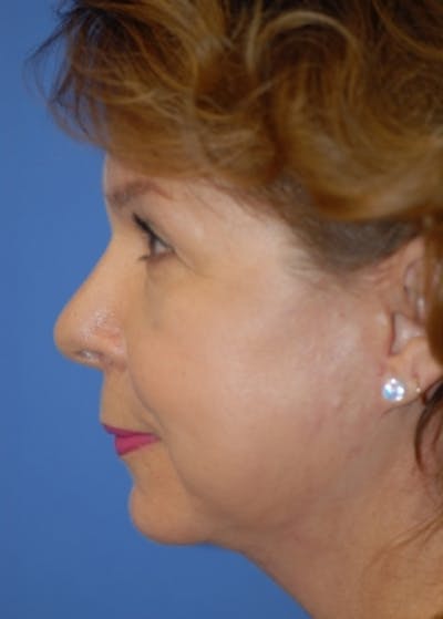 Plastic surgery patient at Allure Plastic Surgery