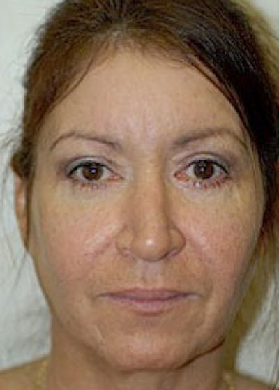 Eyelid Surgery Browlift Before & After Gallery - Patient 5883740 - Image 2