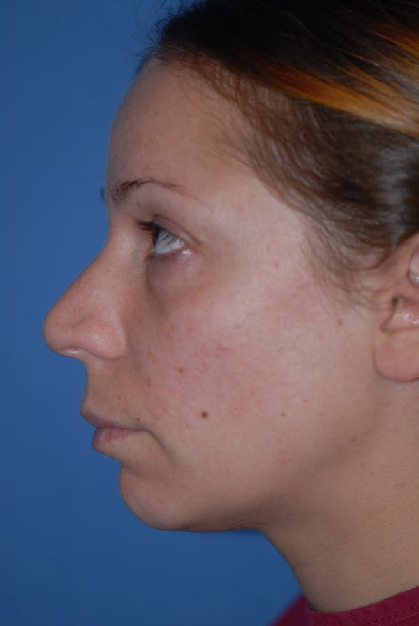 Rhinoplasty Before & After Gallery - Patient 5883741 - Image 3