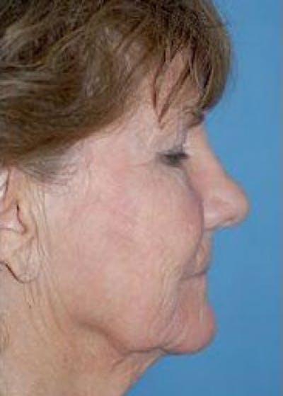 Facelift and Mini Facelift Before & After Gallery - Patient 5883742 - Image 1
