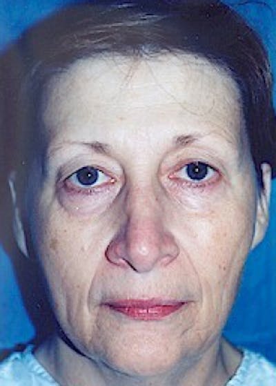 Eyelid Surgery Browlift Before & After Gallery - Patient 5883743 - Image 1