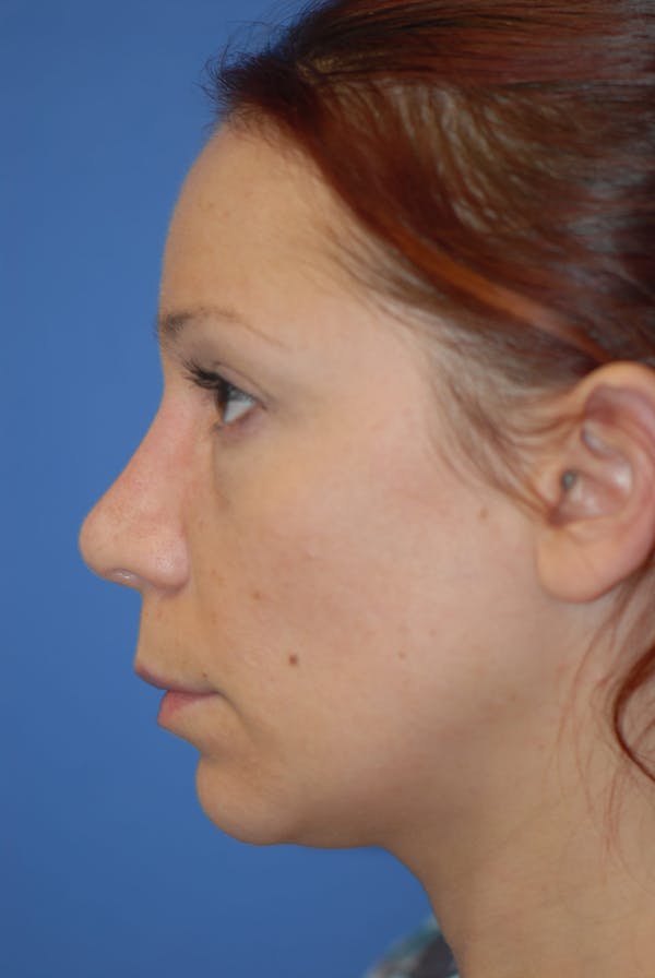 Rhinoplasty Before & After Gallery - Patient 5883741 - Image 4