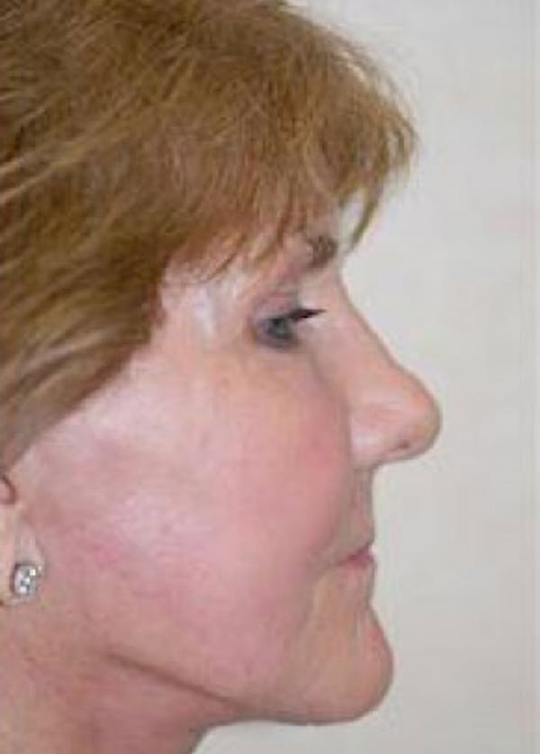 Plastic surgery patient at Allure Plastic Surgery