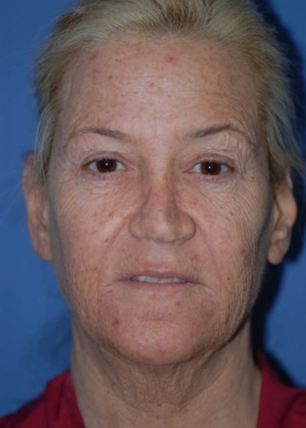 Facelift and Mini Facelift Gallery - Patient 5883747 - Image 1