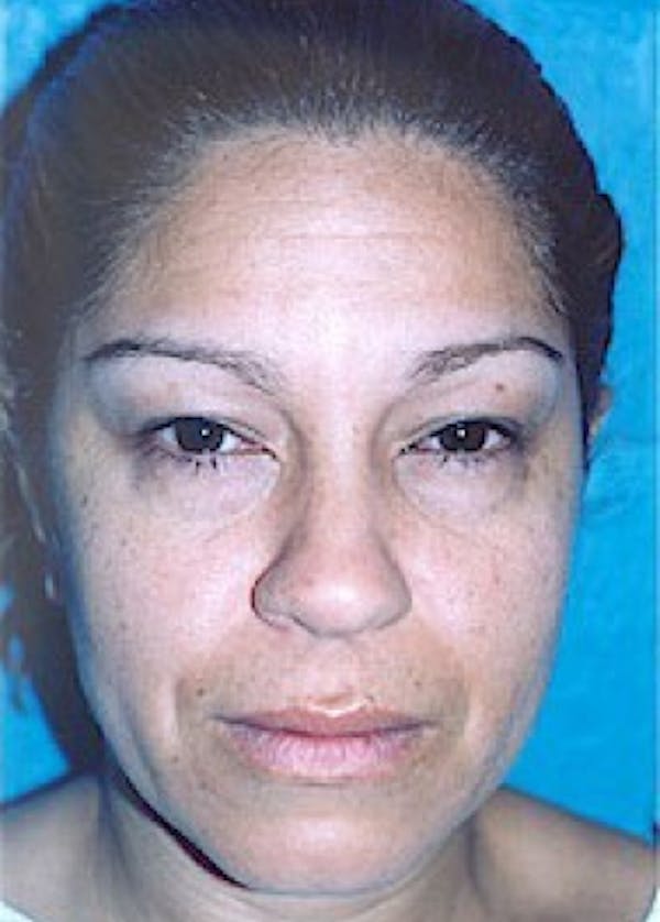 Eyelid Surgery Browlift Before & After Gallery - Patient 5883745 - Image 1
