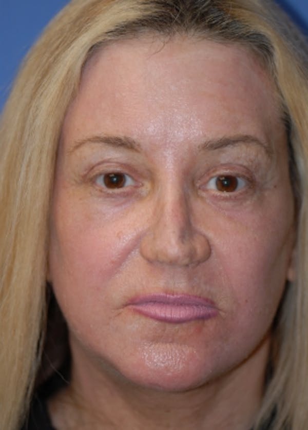 Facelift and Mini Facelift Gallery - Patient 5883747 - Image 2