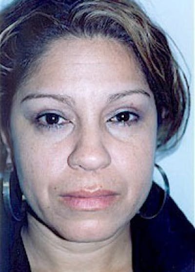 Eyelid Surgery Browlift Before & After Gallery - Patient 5883745 - Image 2