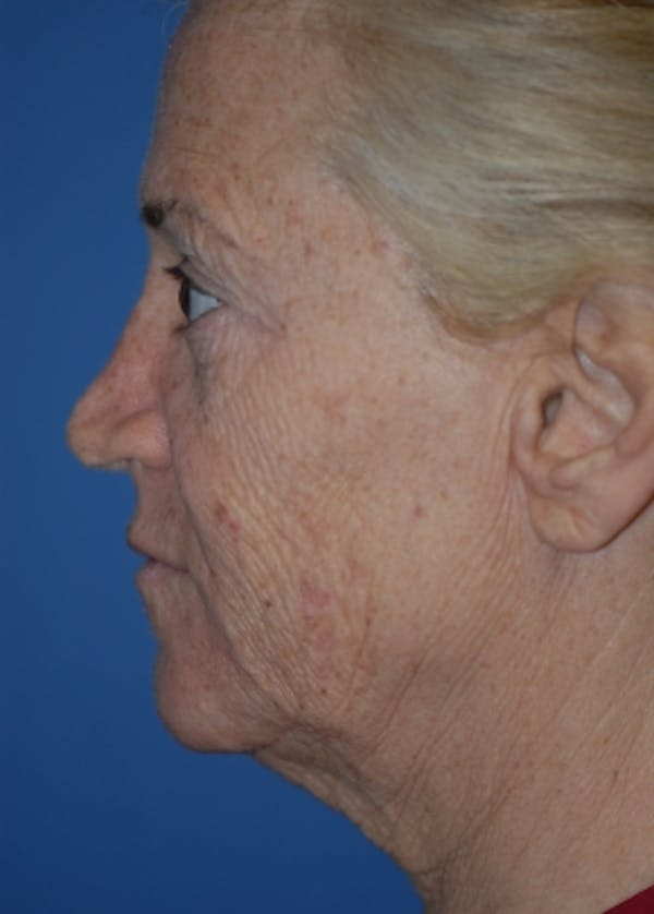 Facelift and Mini Facelift Before & After Gallery - Patient 5883747 - Image 3