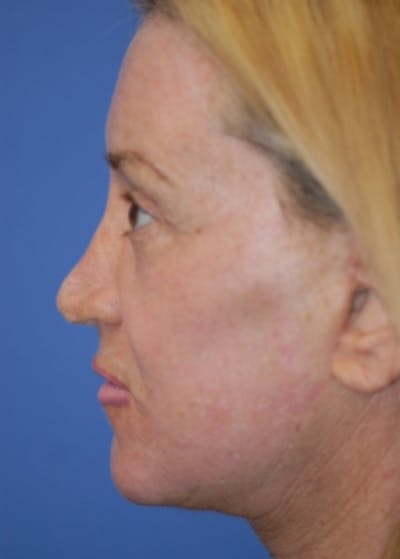 Facelift and Mini Facelift Before & After Gallery - Patient 5883747 - Image 4