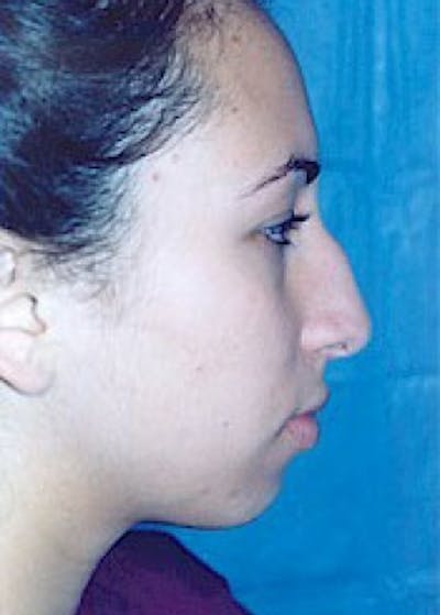 Plastic surgery patient at Allure Plastic Surgery